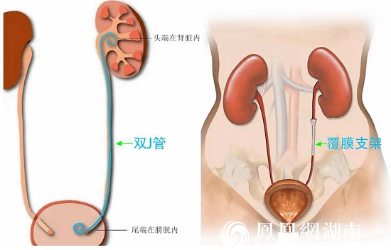 支架再狭窄研究最新进展概述